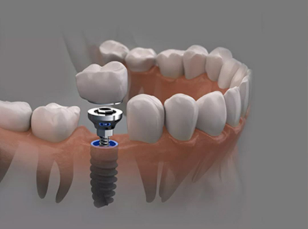 Implant Treatment