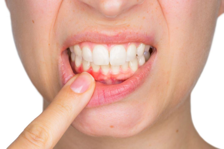 Gums Treatment 