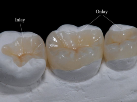 İnley / Onley Treatments